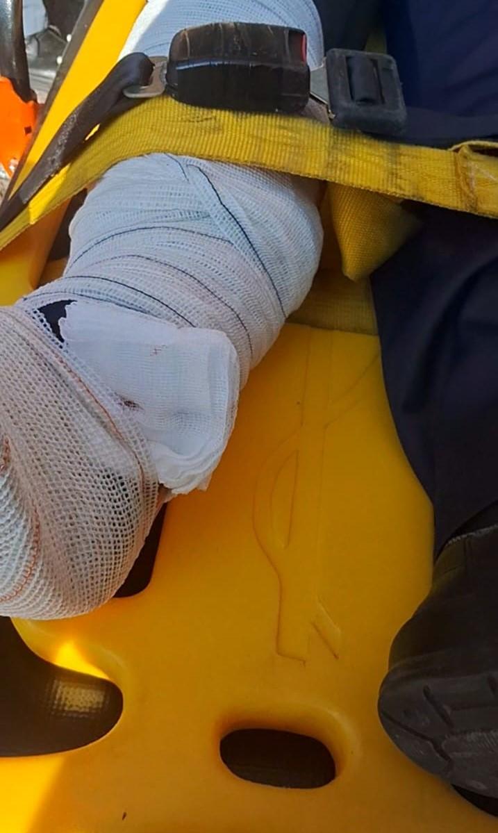 Trabalhador tem fratura em acidente de trabalho